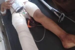 الضالع .. إصابة طفلة بطلقتي قناص حوثي في مديرية قعطبة