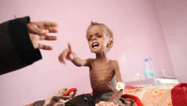 تحذيرات من زيادة حالات سوء التغذية بين أطفال اليمن