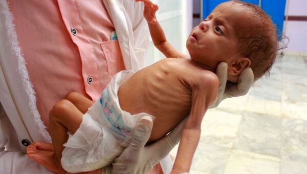 بريطانيا: نصف أطفال اليمن يعانون من التقزم بسبب سوء التغذية
