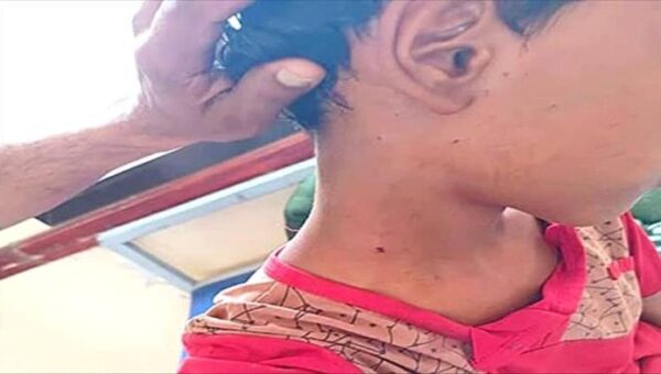 رصاص قناص حوثي يصيب الطفل عواد القوزعي في القبيطة بلحج